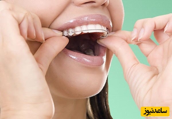 در زمان ارتودنسی چه غذایی نباید خورد