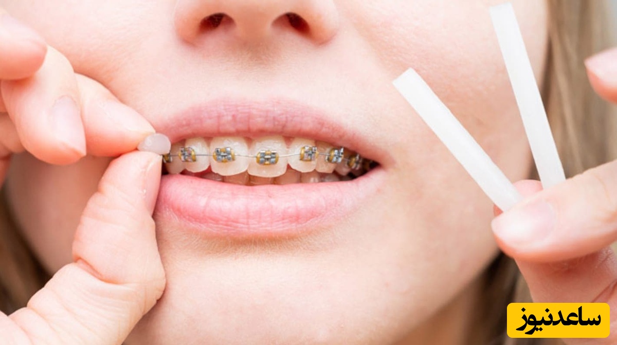 عوارض مهم ارتودنسی که باید بدانید!