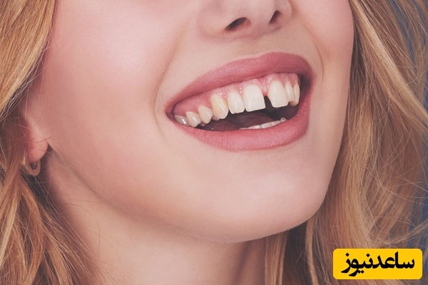 دلیل فاصله ی بین دندان ها چیست؟