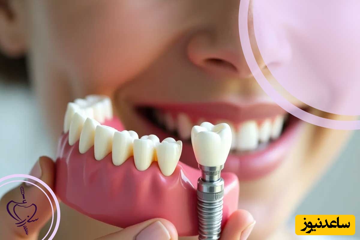 چرا هزینه ایمپلنت دندانی گران است ؟