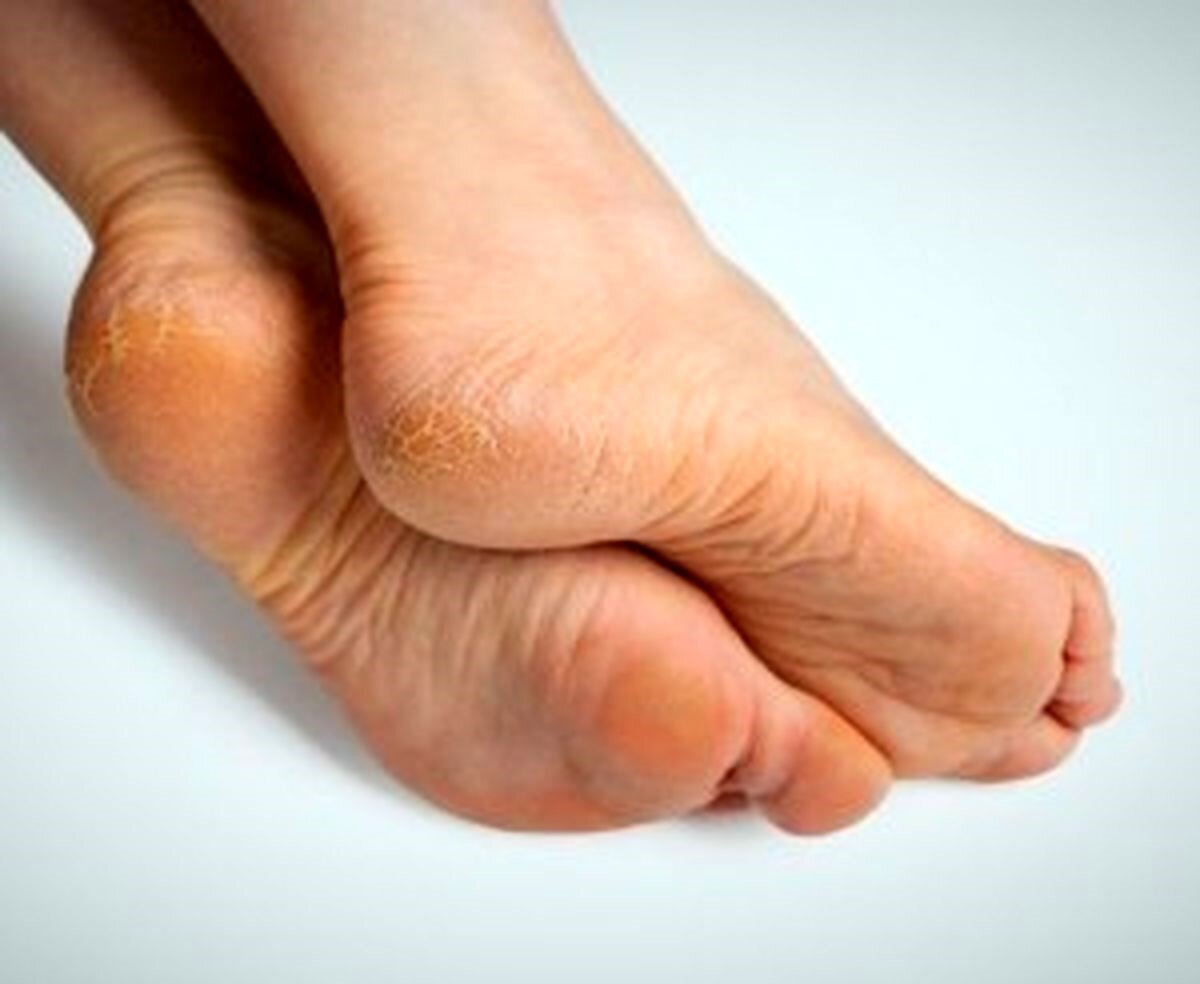 با 8 روش خانگی پوسته پوسته شدن کف پاهایتان را درمان کنید!