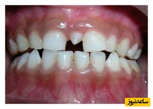 درمان مزیودنس یا دندان اضافی چیست؟