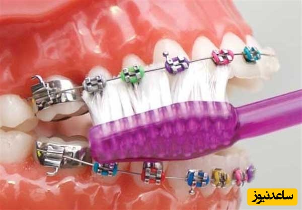 باید و نباید های تغذیه‌ای دوران ارتودنسی