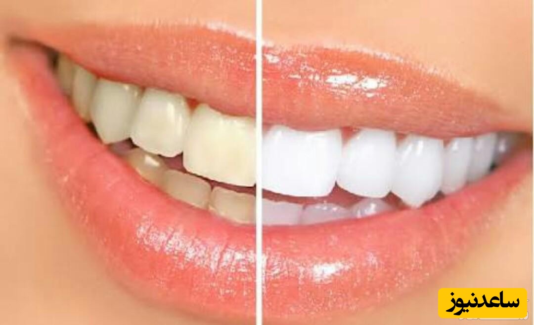 دانستن نکاتی مهم درباره ی جرم گیری دندان