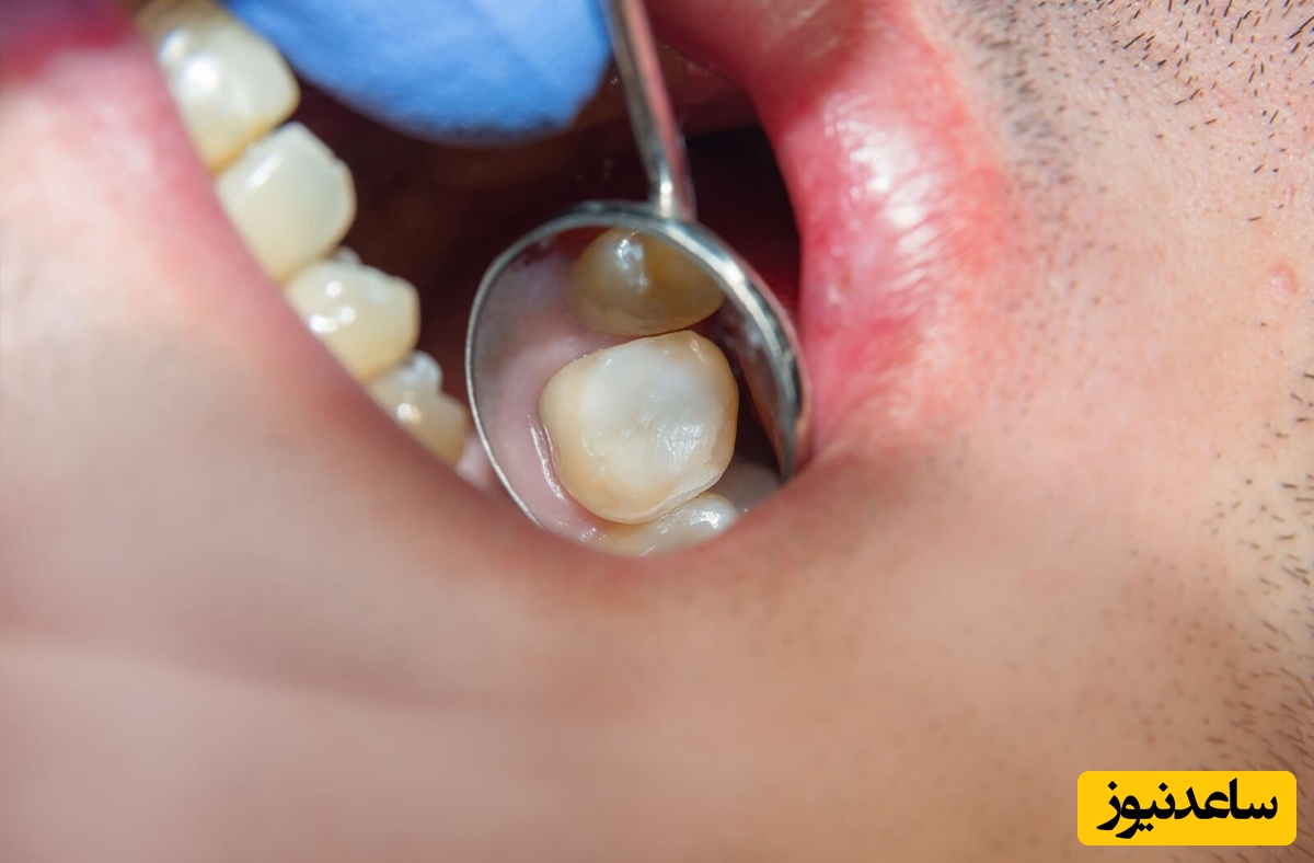 علائم پوسیدگی دندان و جلوگیری از آن