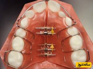 دستگاه فانکشنال ارتودنسی چیست؟