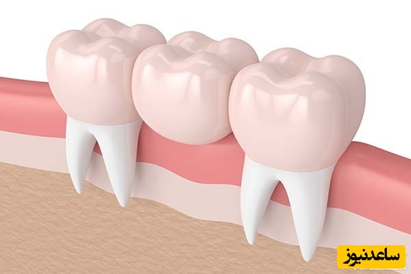 نکاتی برای پیشگیری از مشکلات رایج بریج دندان