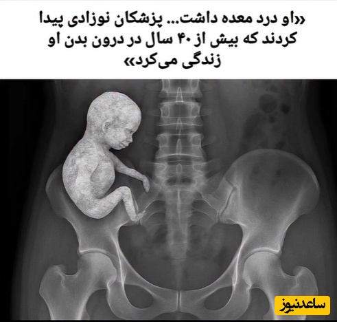 جنین در لگن مادر