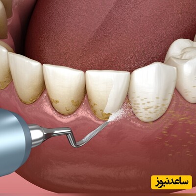 آیا جرمگیری به مینای دندان آسیب می زند؟ / فواید جرمگیری منظم دندان