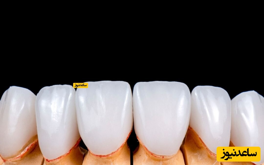 فرق لمینت یا کامپوزیت