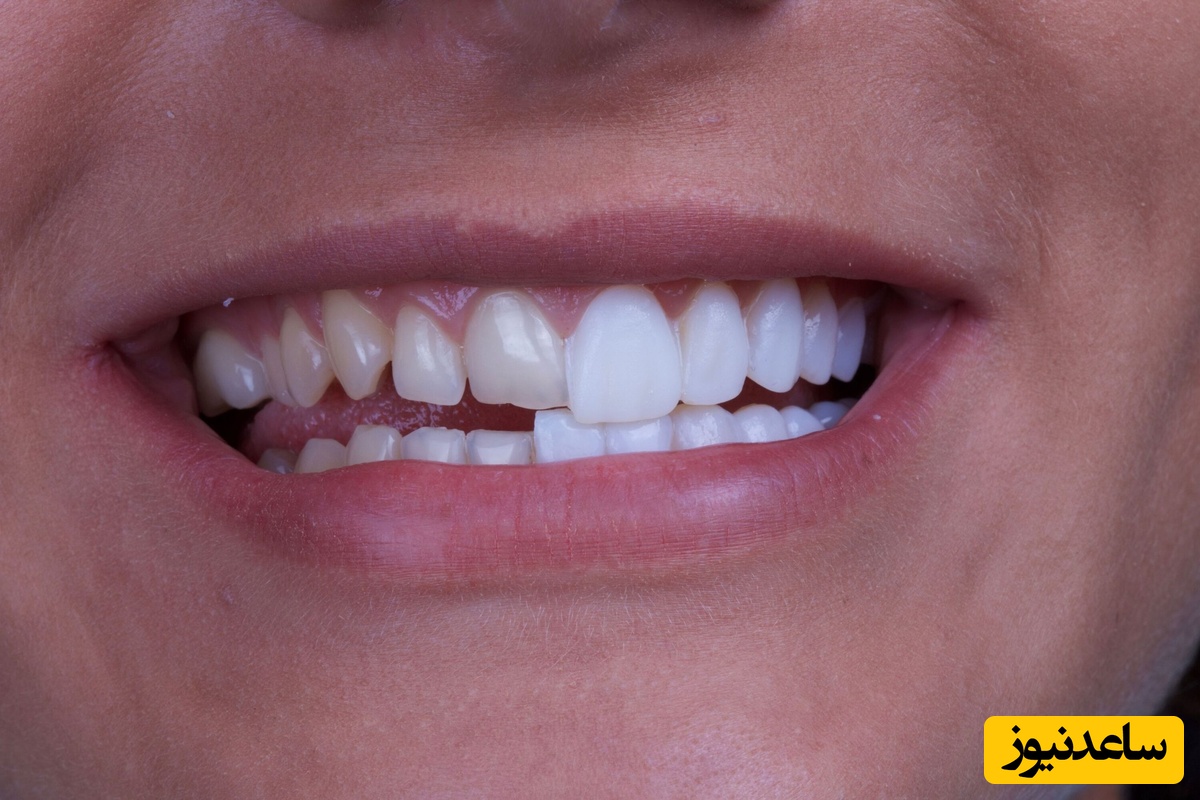 انواع روکش های دندان چیست؟