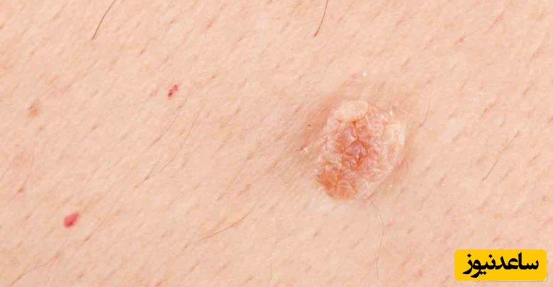 درمان و بهبود زگیل تناسلی با رژیم غذایی