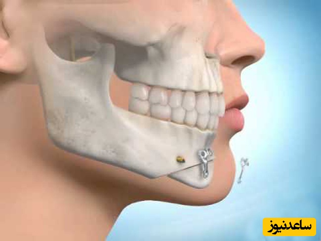 بلوغ و اصلاح مشکلات فکی