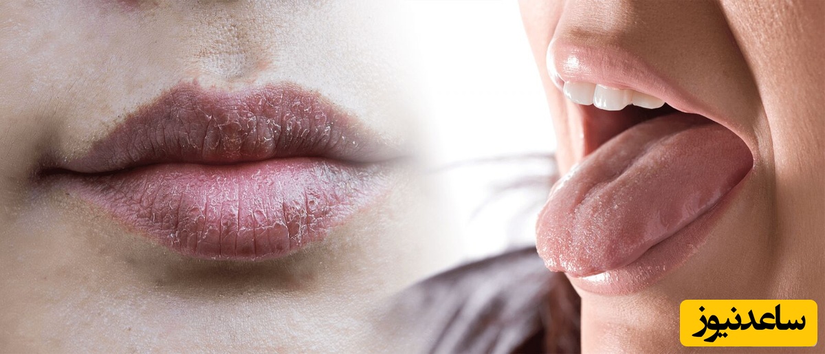 خشکی لب و دهن