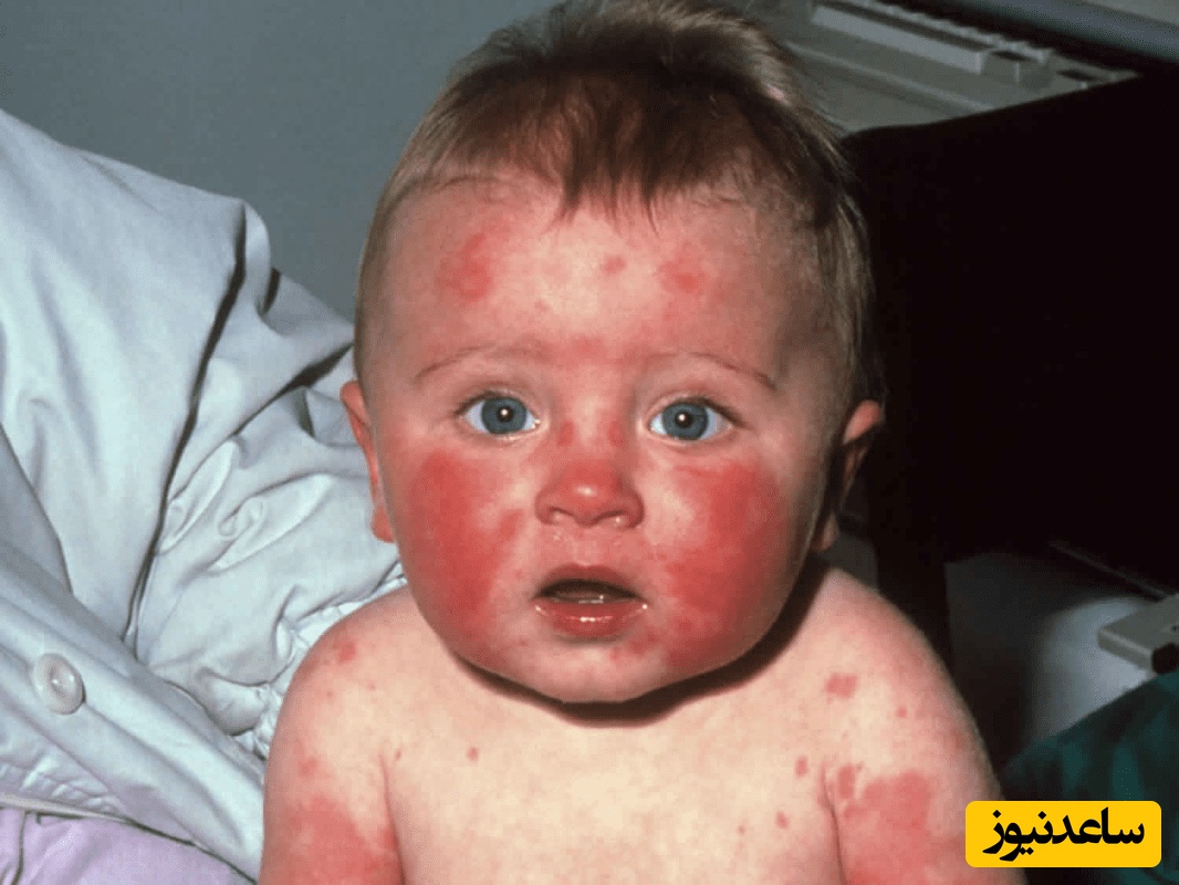 بیماری پنجم