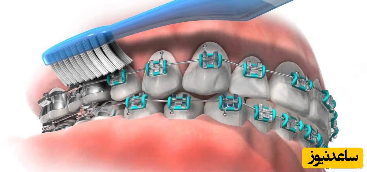 چه افرادی به ارتودنسی دندان نیاز دارند؟