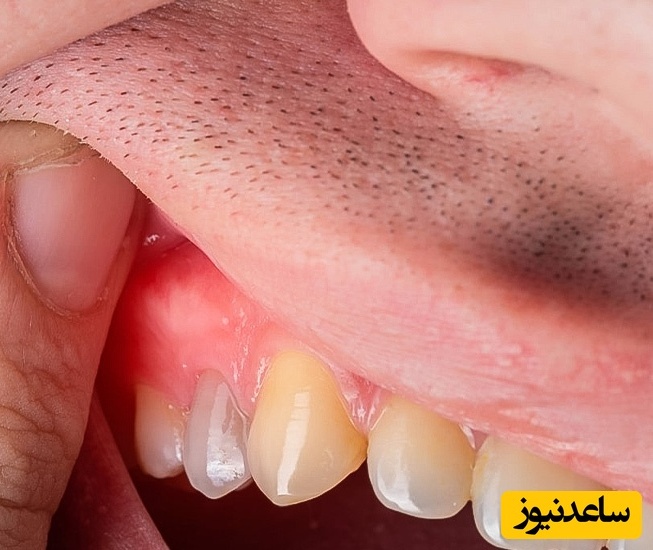 بی توجهی به درمان عفونت دندان چه مشکلاتی به وجود می آورد؟