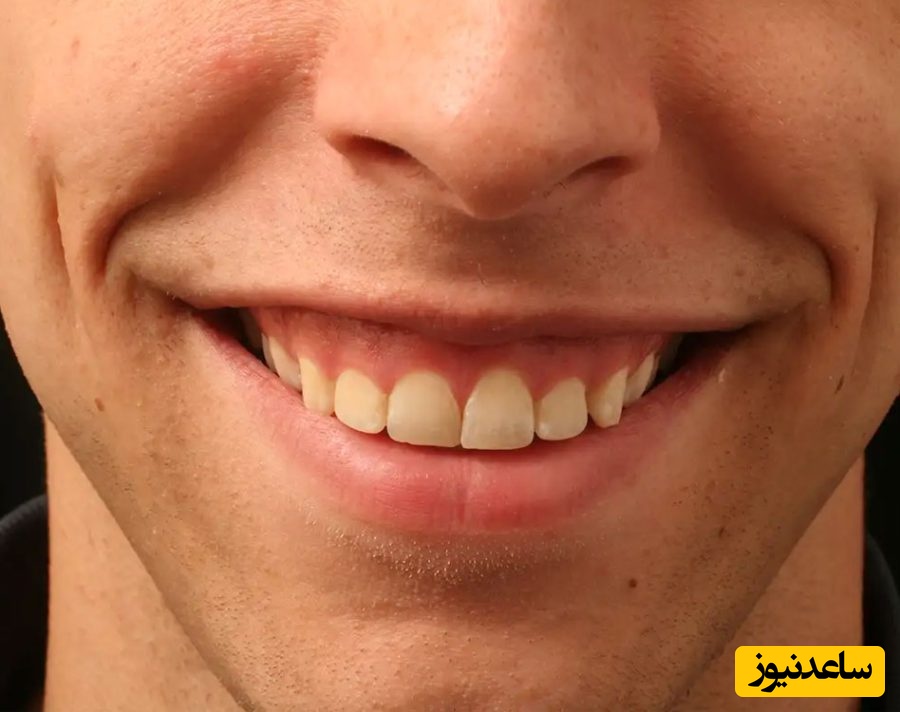 آیا درمان لبخند لثه‌ای بدون استفاده از جراحی امکان پذیر است؟