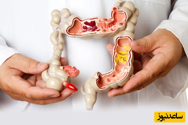 داروی آلوسترون چگونه علائم سندرم روده تحریک‌پذیر را کاهش می‌دهد؟