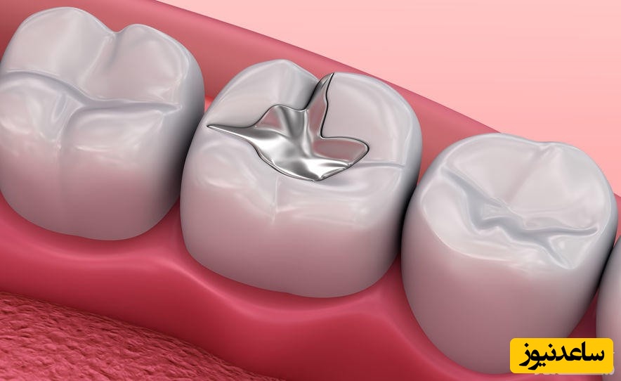 تفاوت بین آمالگام و کامپوزیت چیست؟