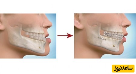 انحراف فک چیست و دلایل آن