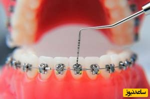 تأخیر در شروع درمان ارتودنسی چه مشکلاتی را به همراه دارد؟