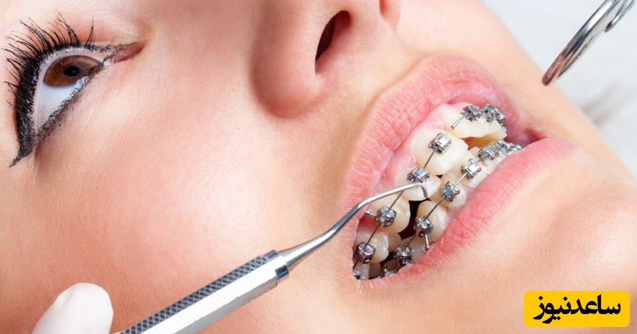 مراحل انجام ارتودنسی در بزرگسالان به چه صورت است؟