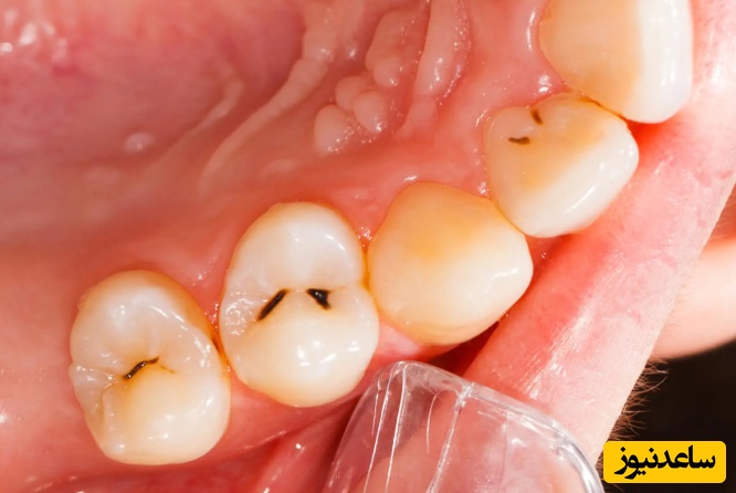 عوامل مهم پوسیدگی دندان را بشناسیم