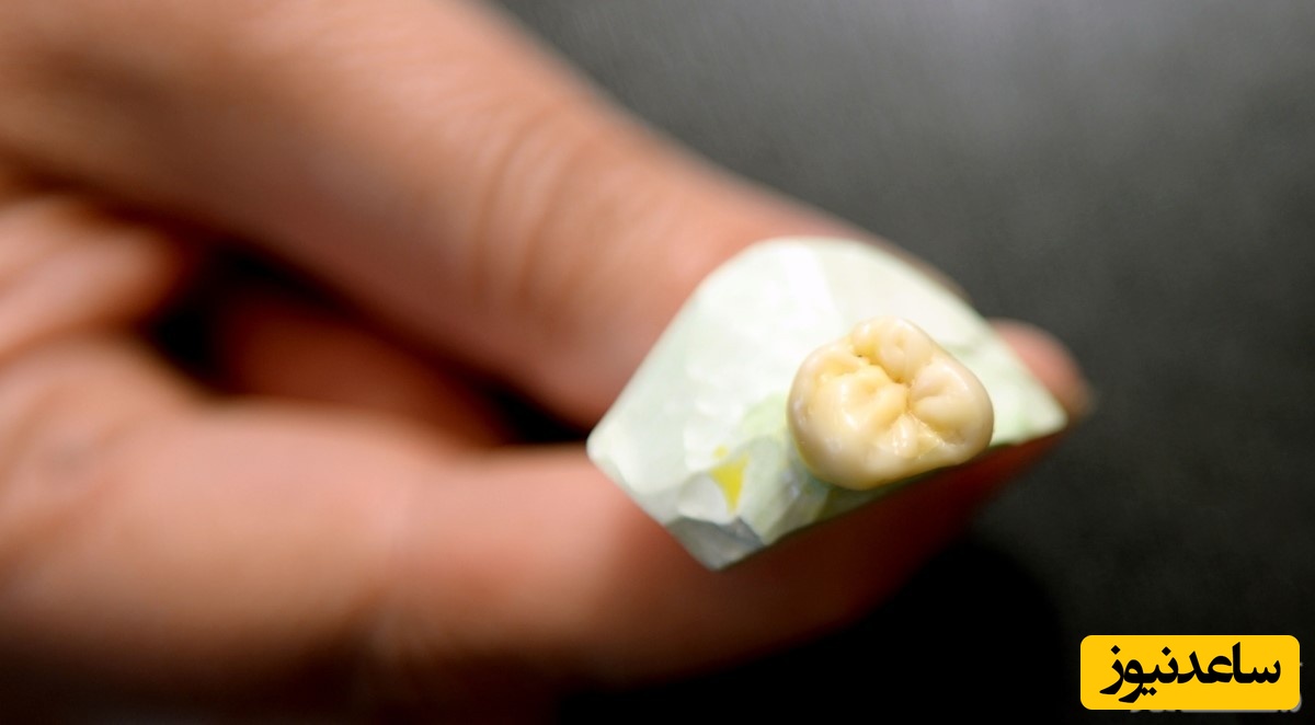 هر آنچه در مورد افتادن روکش ایمپلنت دندان باید بدانید!