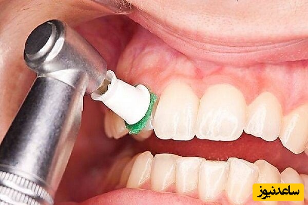 تفاوت لمینت سرامیکی و کامپوزیتی در چیست؟