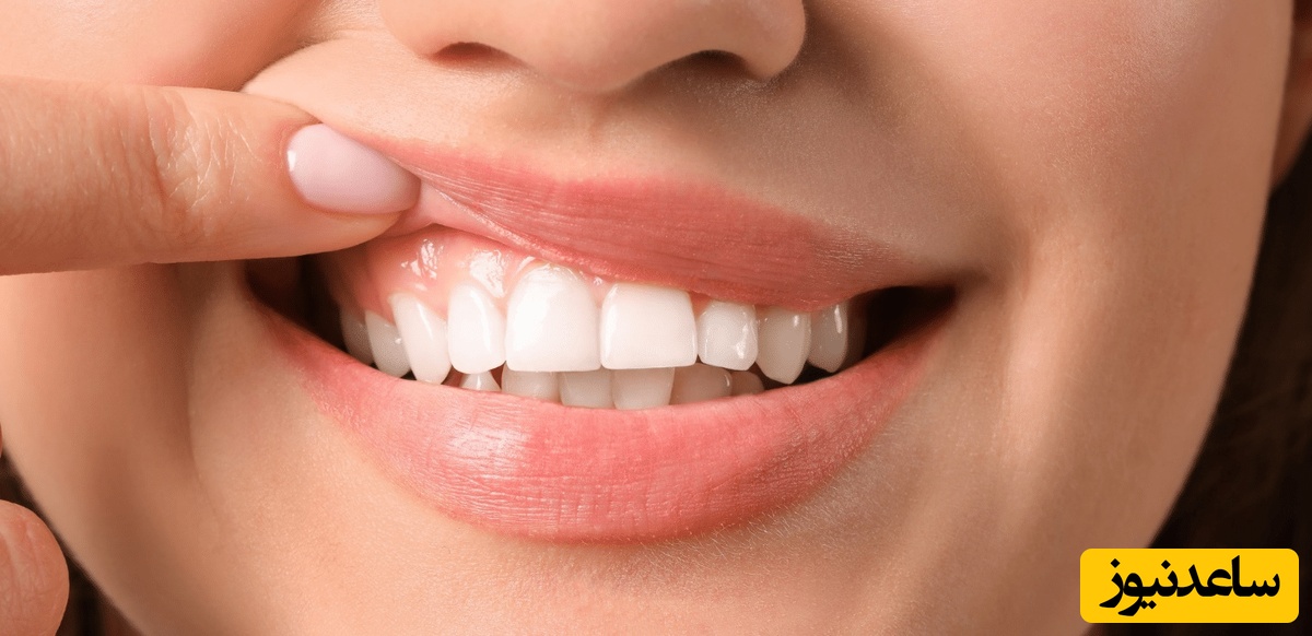 چرا باید لیفت لثه انجام داد؟