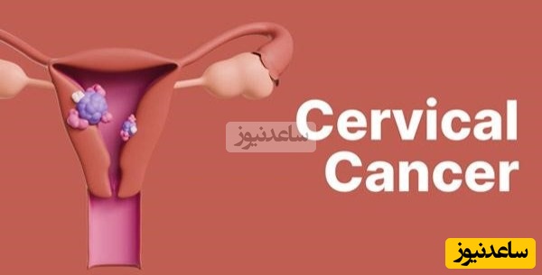 سرطان دهانه رحم؛ علائم، علت و راه‌های درمان و پیشگیری