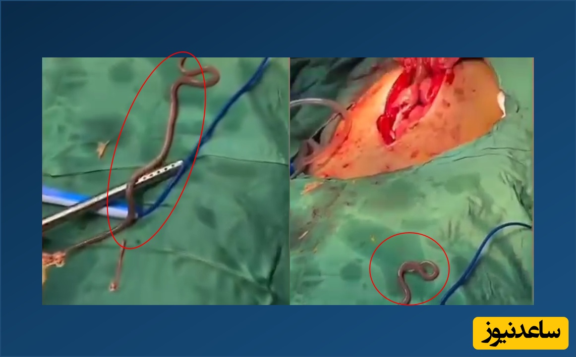 (فیلم) خارج شدن کرم عظیم الجثه از معده بیمار افغانی در کهنوج! 😱😱😱 / وقتی جراح و کادر درمان شوک می‌شوند!