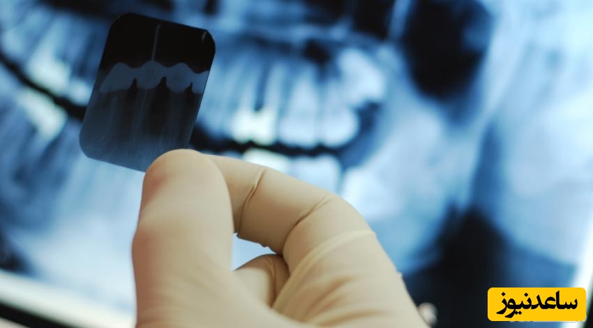 رادیوگرافی تک دندان ( پری اپیکال ) چیست؟