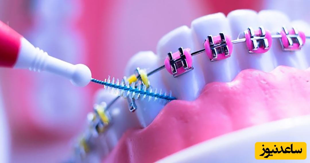 چگونگی شستن صحیح دندان‌ها با وجود ارتودنسی