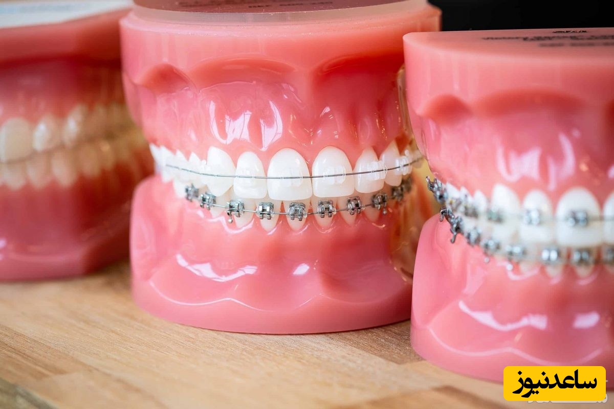 مزایا و معایب ریتینر ارتودنسی چیست؟