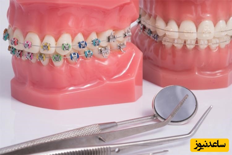 ارتودنسی کاموفلاژ چیست؟