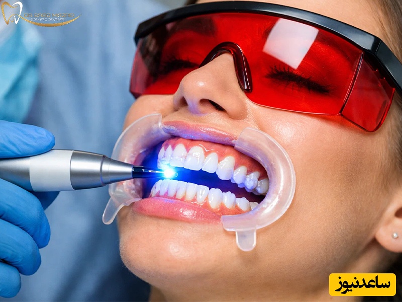 بلیچینگ دندان چگونه انجام میگیرد؟