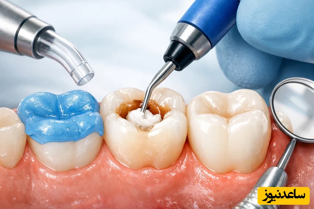 پانسمان موقت دندان چیست؟