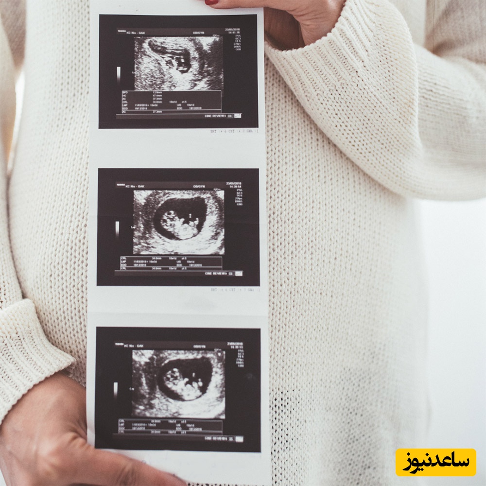 آیا سونوگرافی برای جنین و مادر باردار خطری هم دارد؟