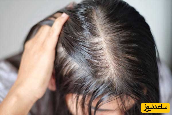 تجمع چربی در موها