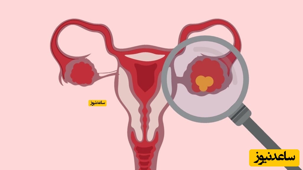 علل و علائم پارگی کیست تخمدان چیست؟