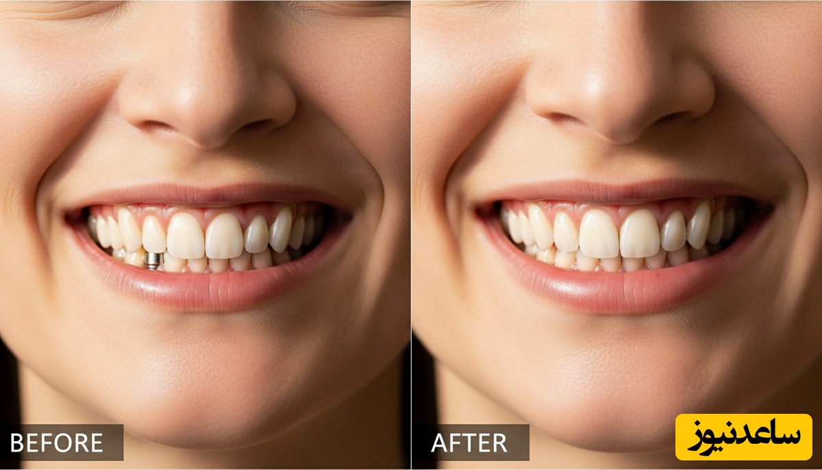 زیبایی دندان جلو