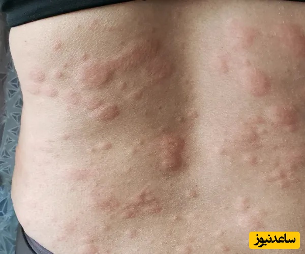 علائم، دلایل و جدیدترین روش‌های درمان کهیر پوستی