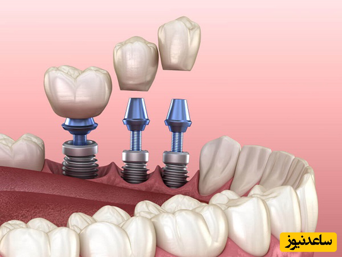 هدف از ایمپلنت دندان چیست؟