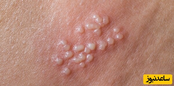 همه چیز درباره ویروس هرپس