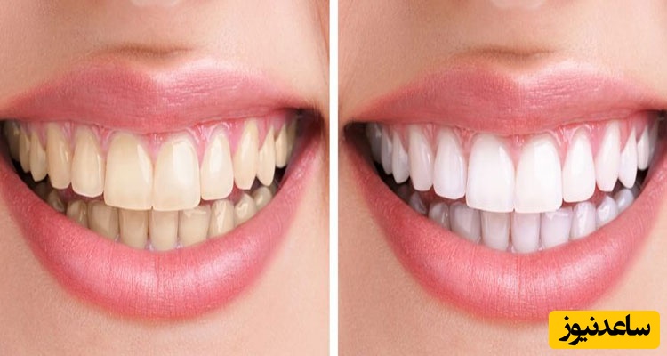انواع کیت سفید کننده دندان