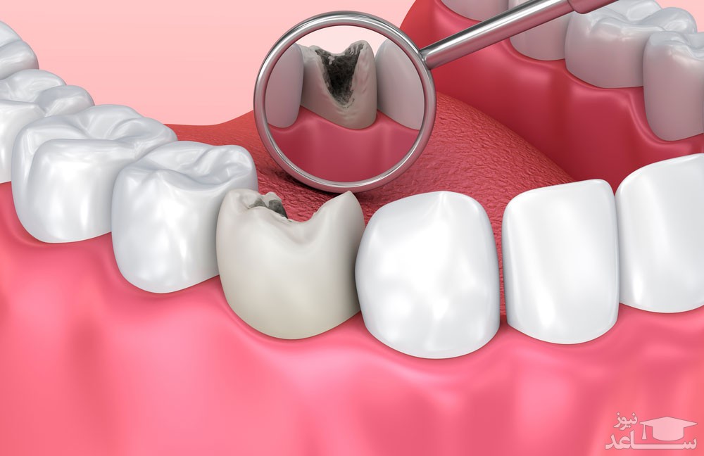 فرایند پر کردن دندان چگونه است و مراقبت‌های پس از آن