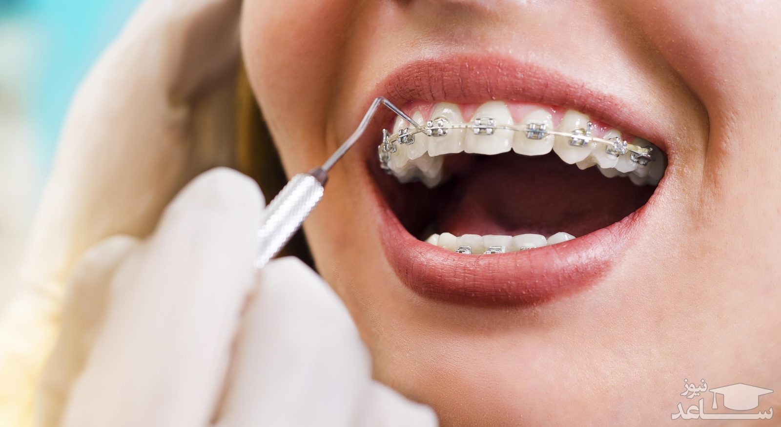 اهمیت استفاده از مسواک های بین دندانی در بیماران ارتودنسی