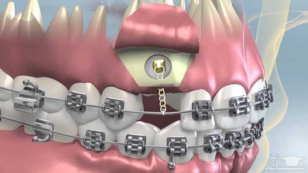 اکسپوز دندان چیست؟